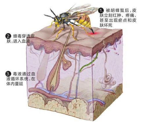 人体肌肤被马蜂蛰后,毒液通过血液循环系统,在体内蔓延.