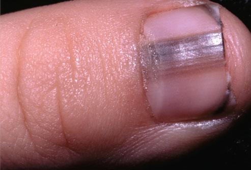 透过指甲看健康:白指甲预示肝病问题(图)(2)