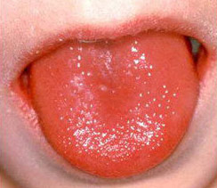 舌头有红色凸起肉粒图片