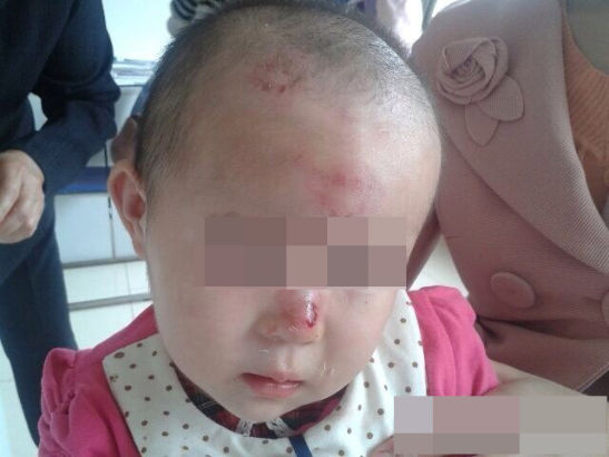 四川遂宁2岁儿童被同学连咬9口