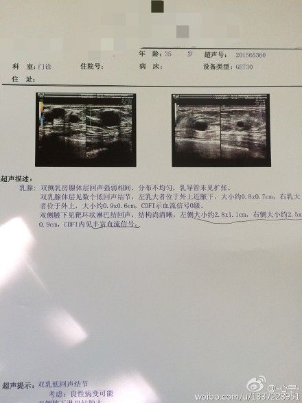 乳腺纤维瘤b超图片图片