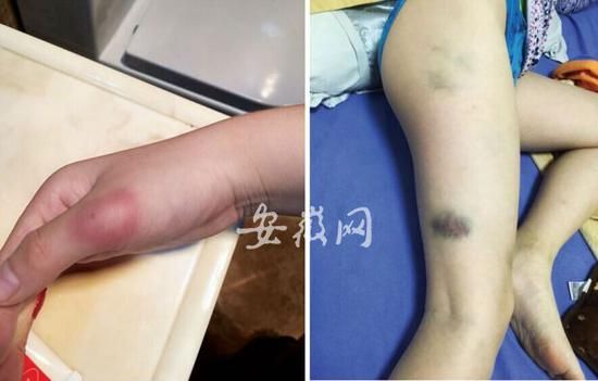 小学生被打多处淤青学校将老师一辞了之