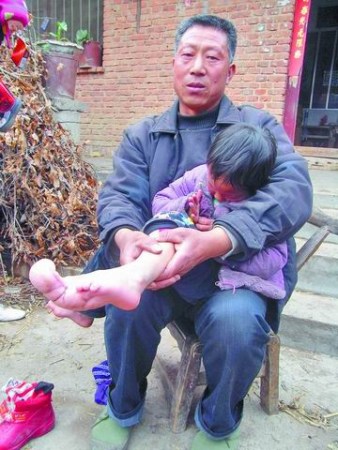 女孩脚趾疯长截趾后长势更旺