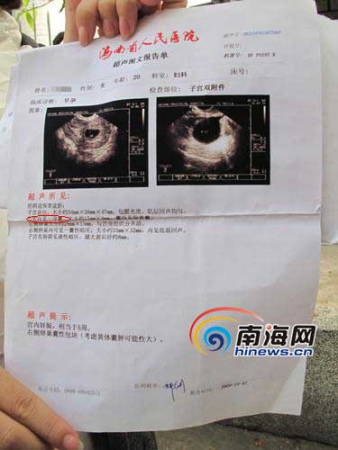 2个月孕囊男孩b超图图片