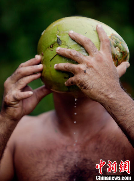 古巴男子天生24只指头爬树本事强