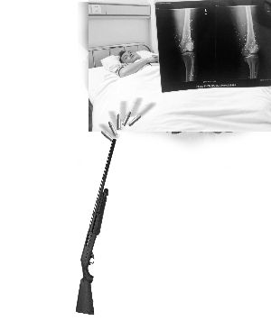 邵振才双腿被击中两枪,从x光片上可以看出,其膝盖