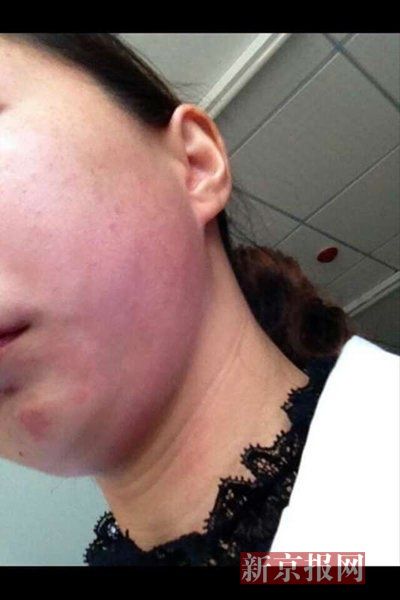 李晓莹发来的受伤部位照片显示,左脸可见大面积红肿