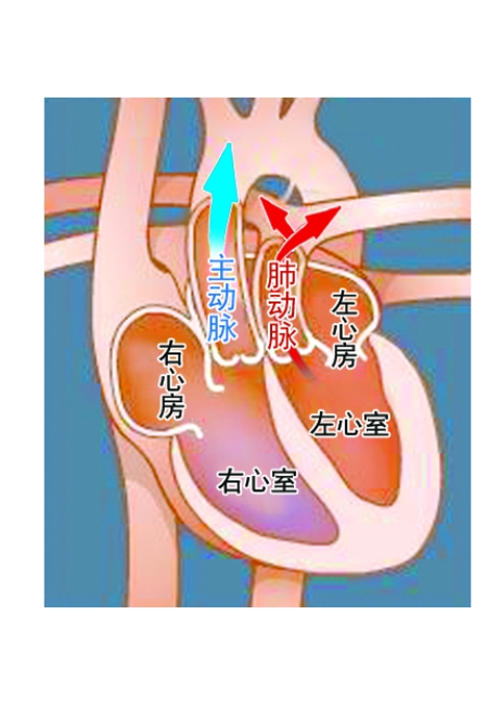 大动脉异位图片