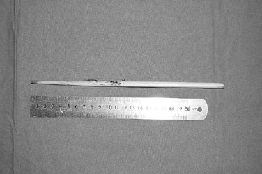 12厘米长筷子由鼻孔"原路"拔出