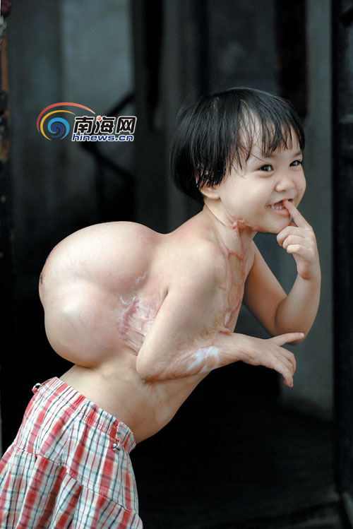 站立时明显驼背 残疾女孩急需做二期手术