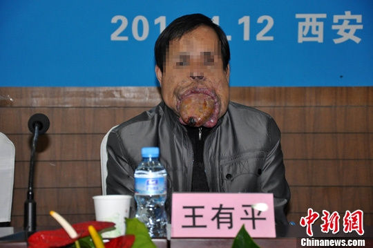 西安收治世界罕见巨舌症患者舌体突出于口腔外