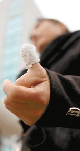 讯 和一般人不同,在金华打工的李仁琴的左手大拇指边上多长了一只手指