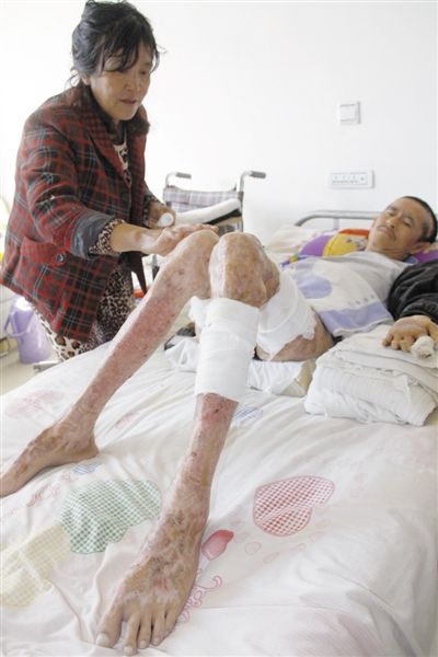 李军被高压电灼烧之后