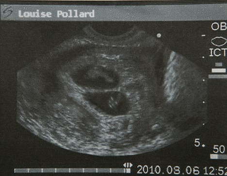 孕囊b超图图片
