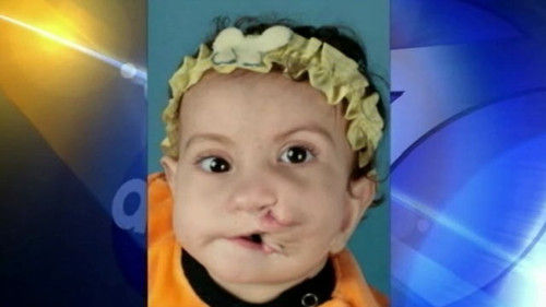 埃及女婴面裂生来"两张嘴" 术后恢复笑容(图)