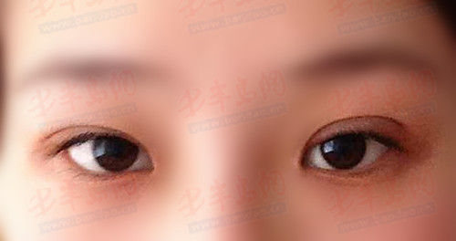 林菲(化名)动完手术后,两只眼睛明显不一样