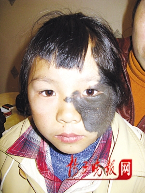 兽皮症少女成功变脸