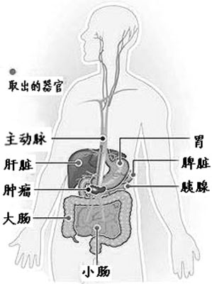 美国63岁老太掏空腹腔切肿瘤