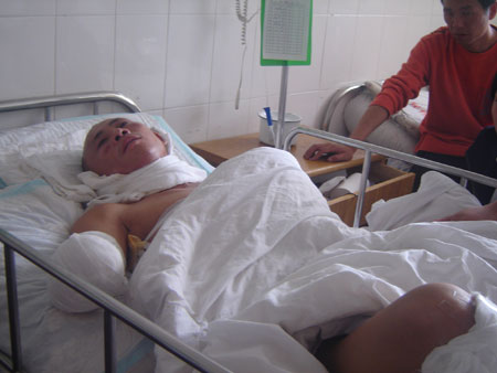 南昌临时工架设缆线被电残右手右腿图