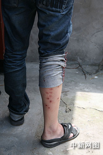因"来钱快" 浙江一男子在腿上扎洞称被狗咬伤