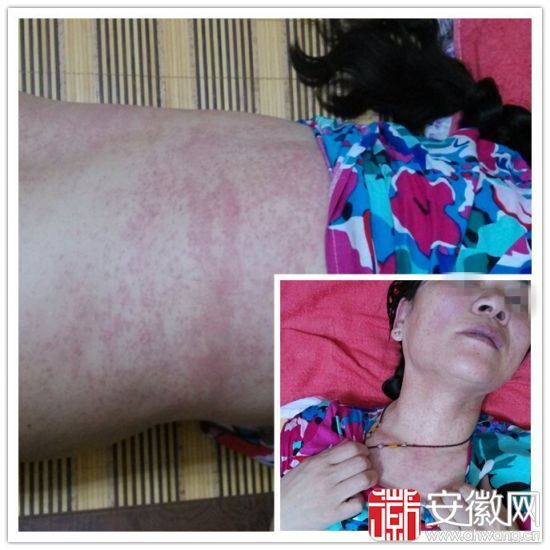 女患者术后出药疹面部浮肿医生说其长漂亮了