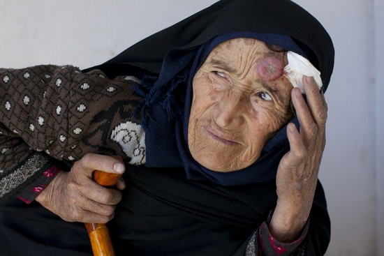 阿富汗皮肤黑热病肆虐 数万人面临毁容威胁(图)