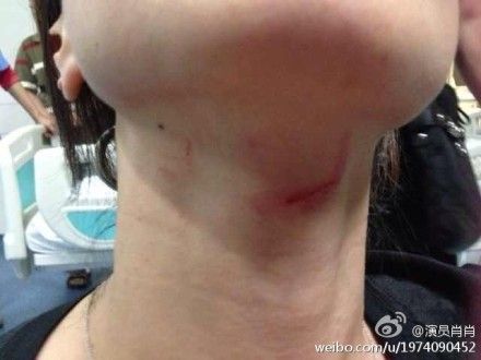 女生打架伤口照片图片