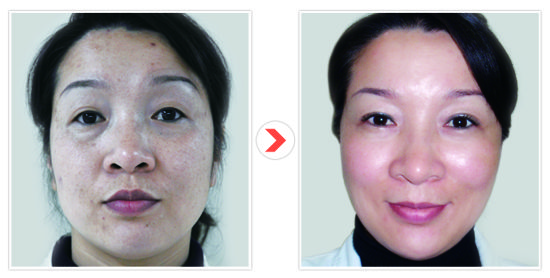 逸美玻尿酸_新浪健康_新浪网