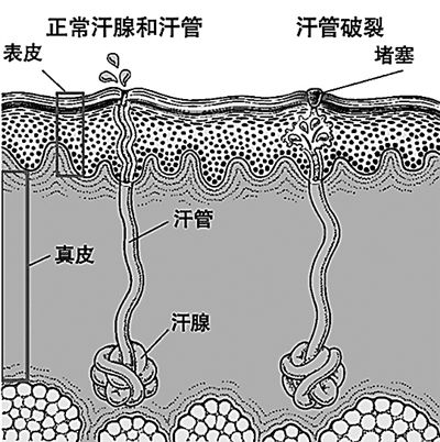 在連續高溫及高強度訓練中,許多官兵脖子,前胸出現