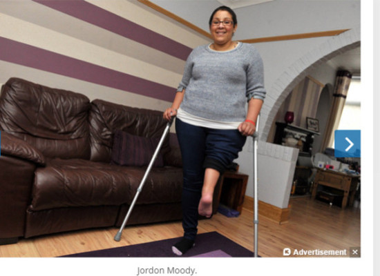 英骨癌女截肢又接回小腿翻转180度脚跟变膝盖