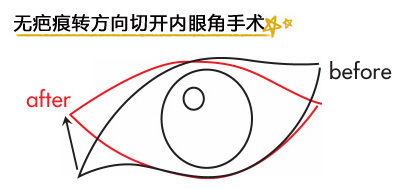 无疤痕转方向切开内眼角手术示意图