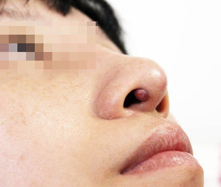 鼻粘膜肿效果图图片